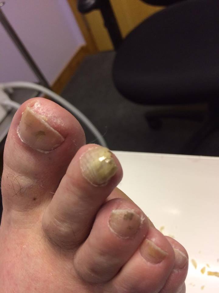 Fungal Toenail