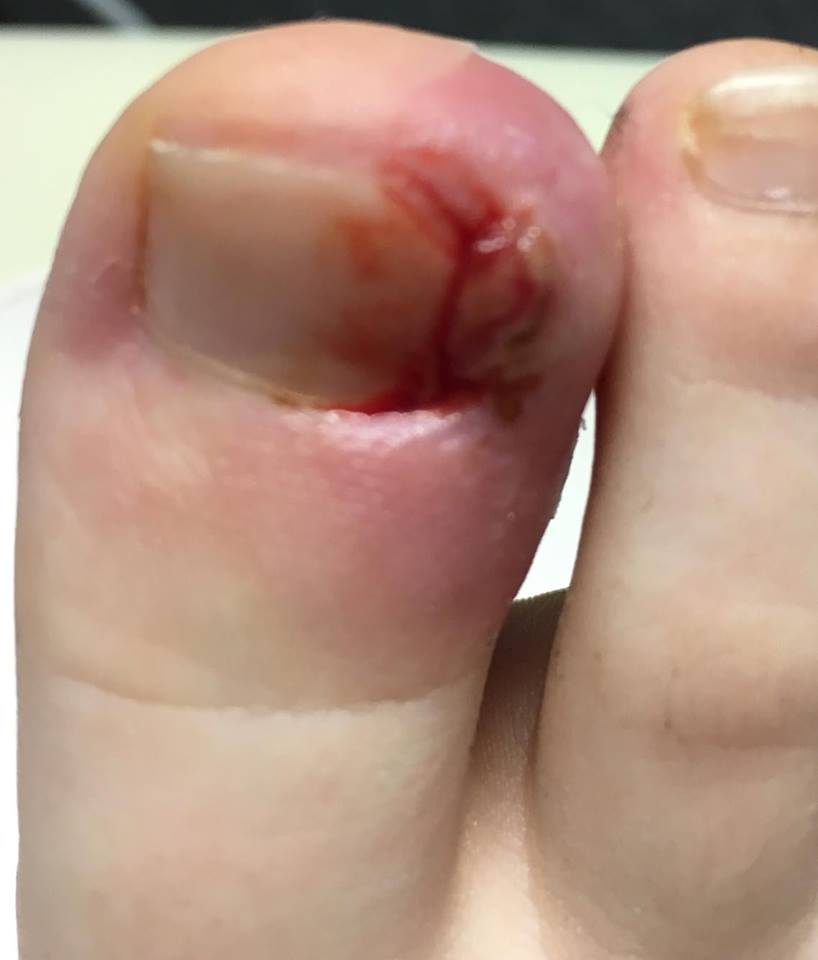 Ingrown Toenail