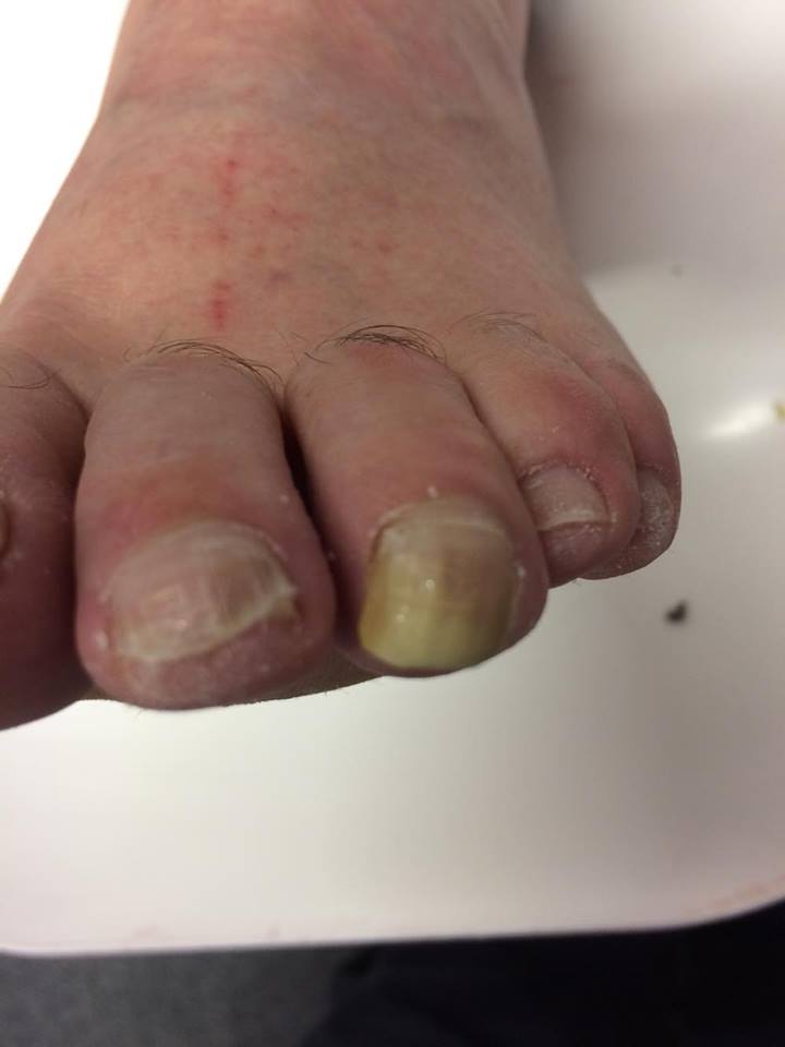 Thickened Toenail